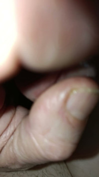 Is My Meatus Open?