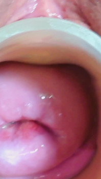 Cervix e prolasso midline