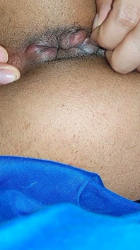 Hemorrhoids in the Ass
