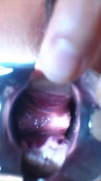 Speculum Cervix & Anal Exam Great View Inside