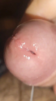การแตกของ Phimosis สูงสุด