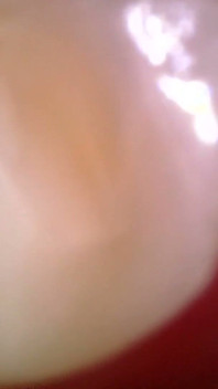 Medical Endoscope Oral Exam: Gummy Chewing, Extreme Teeth & Tongue Macro