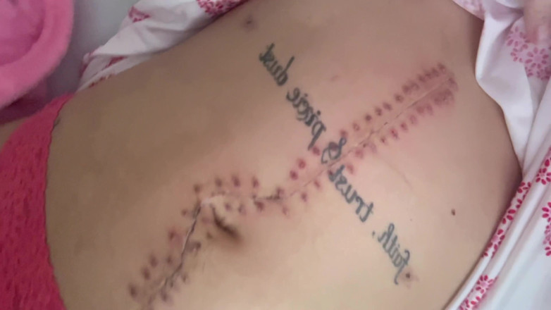 Nali Marie: Scar Fetishes Stitches Staples Pemulihan Hospital Selepas Pembedahan Remaja kecil...
