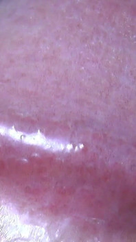 Tayson's glands or pearly papules