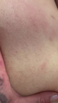 Henüz blistered veya bruised değil