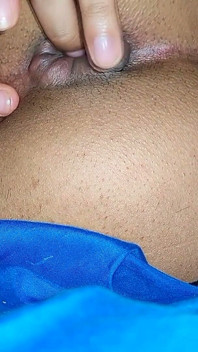 Hemorrhoids in the Ass