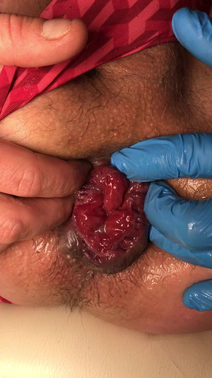 Nalekhome: Finger in My Prolapse