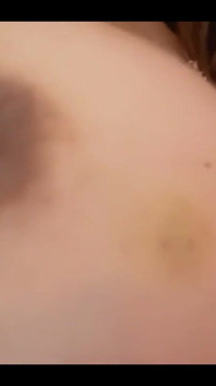 Bruise on Tits Update
