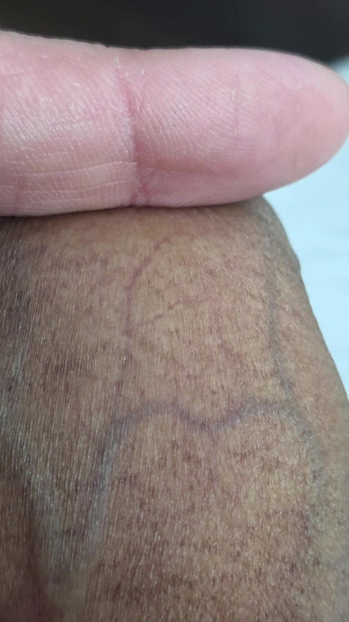 Lkdick8: Apakah bintik-bintik ini pada zakar saya