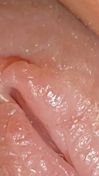 Enlargement of the Deep Urethral Hole!!