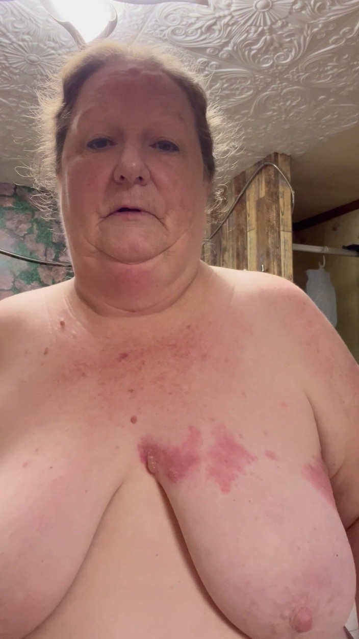 PlayfulRose1: Caz rău de zona zoster