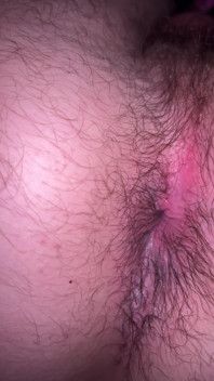 Bruised Asshole