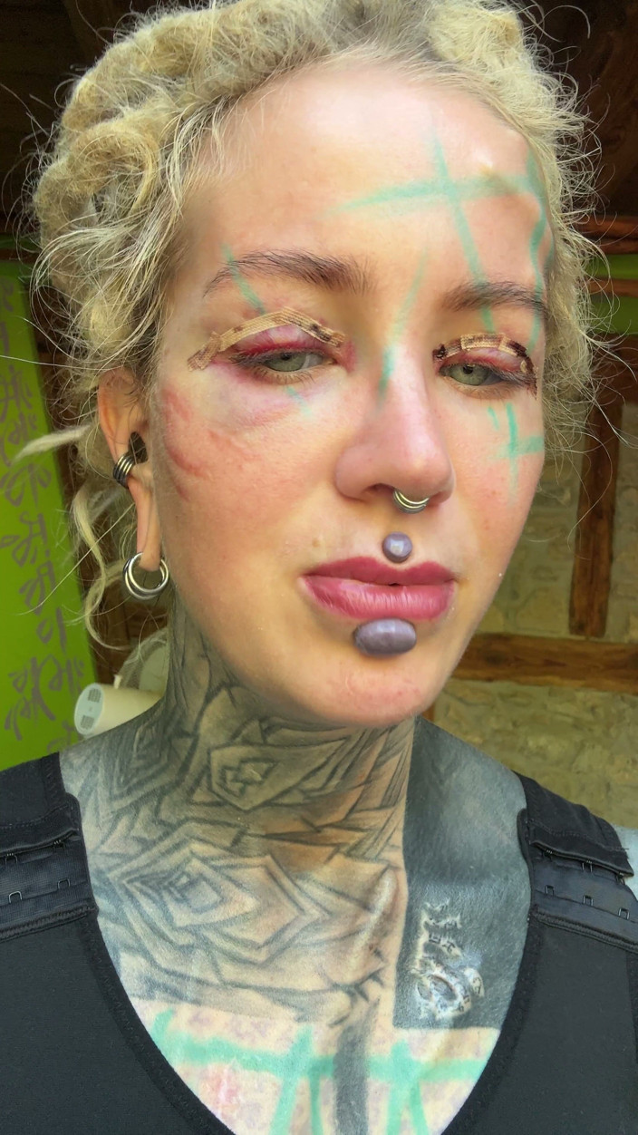 Anuskatzz: Day 3 After My Boobs and Upper Blephoplasty Op