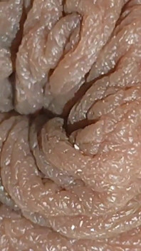 The World's Largest Foreskin Opening and Closing.