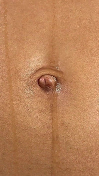 Tillbe min navel