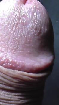 Tayson's glands or pearly papules