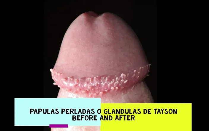 Ansel Kenzo: Tayson's glands or pearly papules