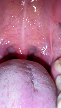 Mouth Secrets: Thick White Coating on My Tongue