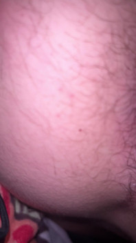 Bruised Asshole