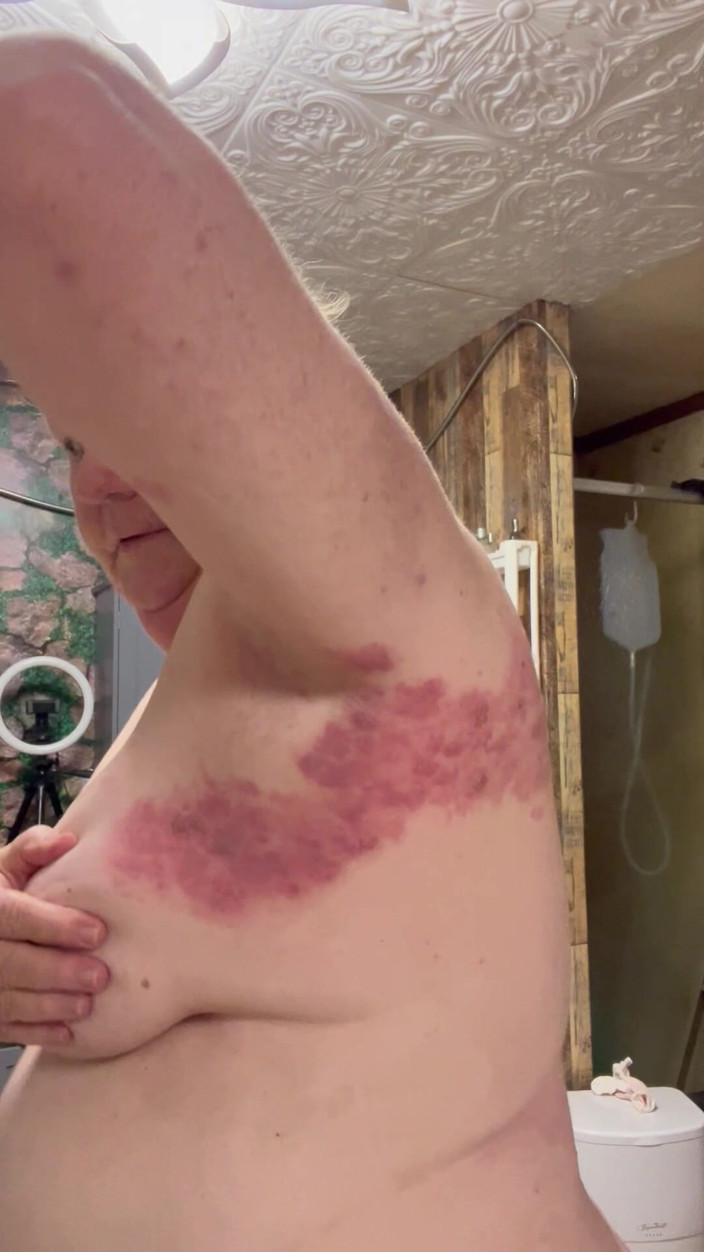 PlayfulRose1: Kes Buruk Shingles