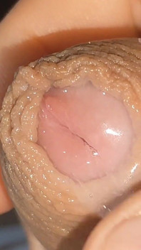 Curious Close-up of Pre-cum in Flaccid Phimosis.