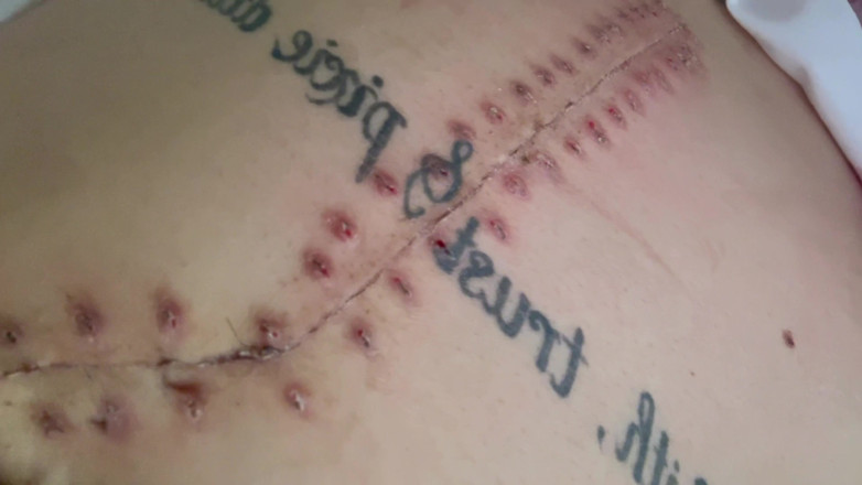 Nali Marie: Scar Fetishes Stitches Staples Hospital Recovery After Surgery Teen Petite...