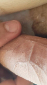 Le Phimosis Non Circoncis Provoque La Première Éjaculation.
