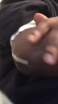 Amputee Stroking Armstump