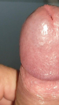 Large Deformed Cock with Lumpy Glans.