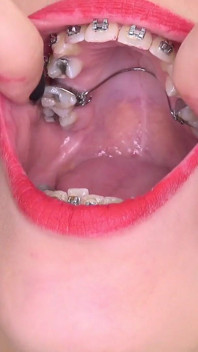 Video fetish della bocca con Bara che mostra l'apparecchio dentale.