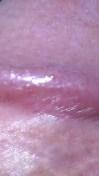 Tayson's glands or pearly papules