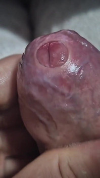 Uncut Tight Phimosis Cock Foreskin Stretched Close up