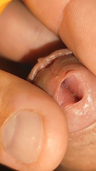 Young Straight Man Inserting the Tool Through the Glans.