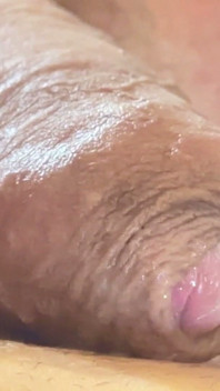 ¡fimosis Venosa Extrema En La Bomba!