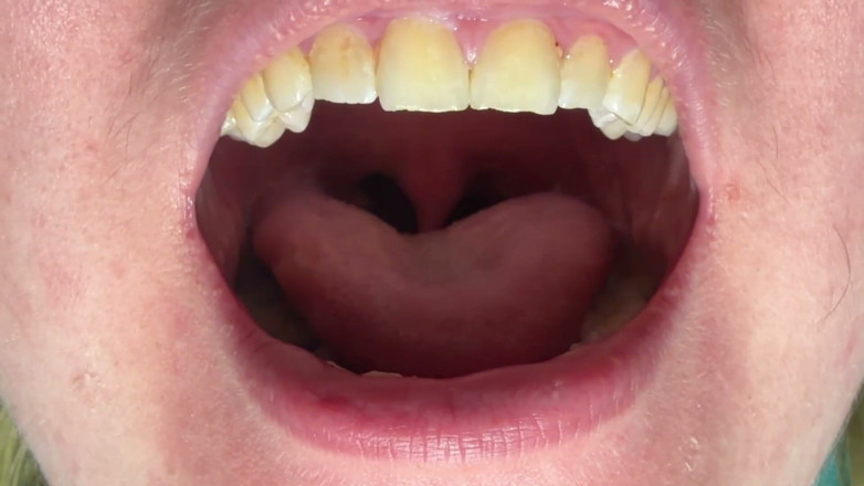 Spunk Kip: Mouth &amp; Tonsils Close-up