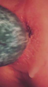 Dilatation Anal