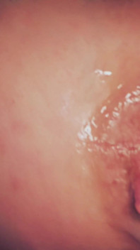 Dilatation Anal