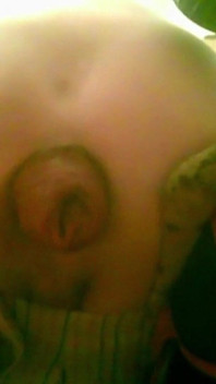 A Young Guy Is Sitting on a Chair with Anal Prolapse