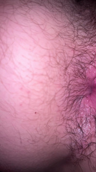 Bruised Asshole