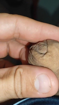 Inserting the Super Glue Through the Boy's Glans.