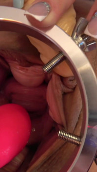 Cervix Vibration Play
