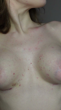 Revealing My Boobs After Breast Reconstruction (3-week Progress Update)