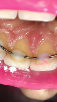 Permanent Retainers Mouth Tour