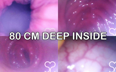 Lina Free: Endoscopio anal hasta el camino en mi colon transverso!