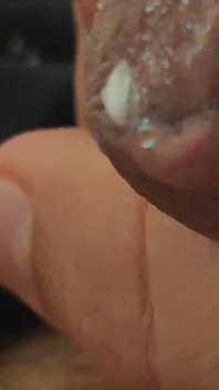 Immense Phimosis Being Extracted Cum and Précum.