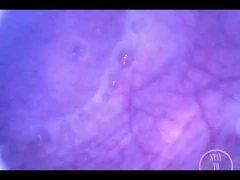 मिनिकैम अंदर के साथ मेरे पूरे ब्लैडर में हवा पंप करना