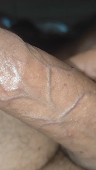 I Have the Largest Ejaculating Phimosis in the World!!