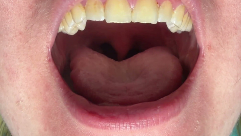 Spunk Kip: Mouth &amp; Tonsils Close-up