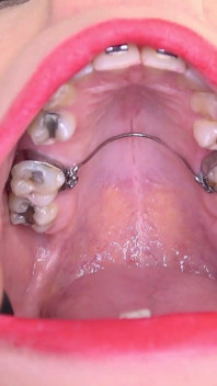 Video de fetiche de boca con Bara mostrando frenillos dentales.