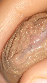 Curioso Close up De Pré Cum Na Fimose Flácida.